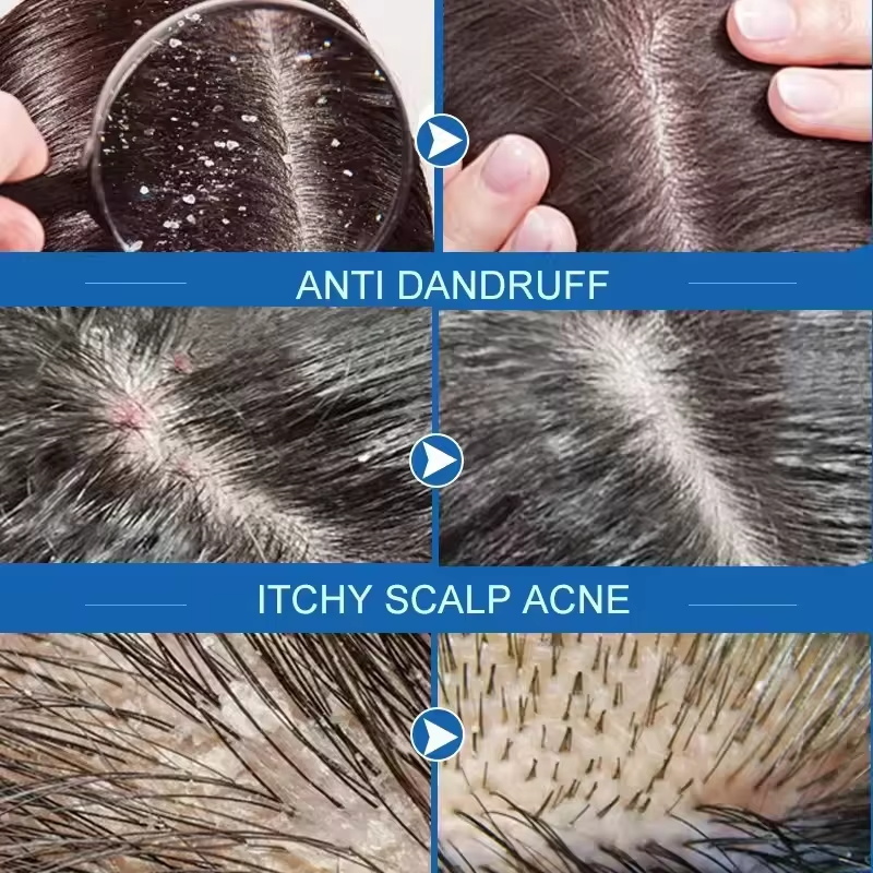 Fast Anti Dandruff Hair Treatm - Hair Care Dandruff review and price