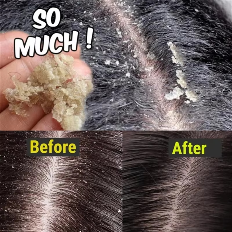 Fast Anti Dandruff Hair Treatm - Hair Care Dandruff review and price